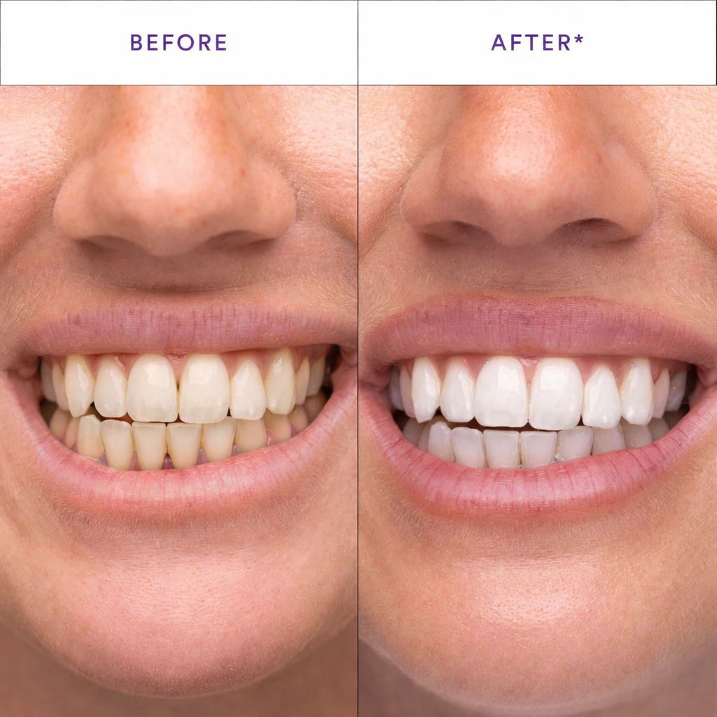 Purple Teeth Whitening Strips